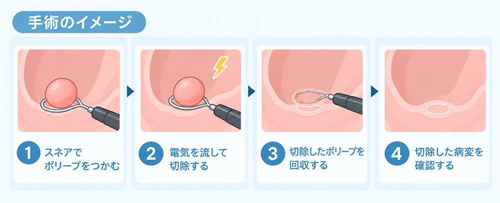 内視鏡的ポリペクトミー（ポリープ切除術）
