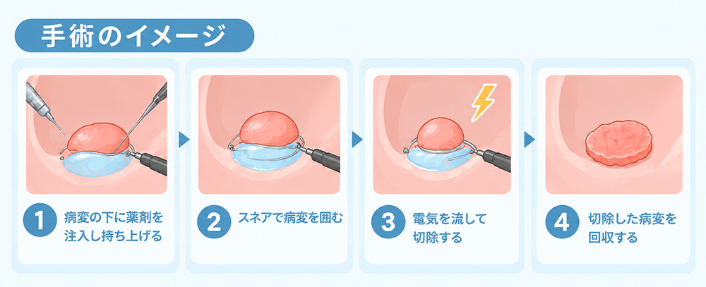 内視鏡的粘膜切除術（EMR）